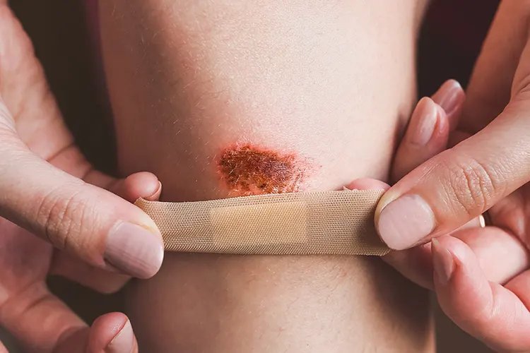 Accute inflammation 1